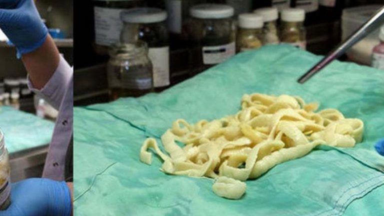 Tenya nedir ve neden oluşur? Tenya nasıl yok edilir, tenya nasıl tedavi edilir?